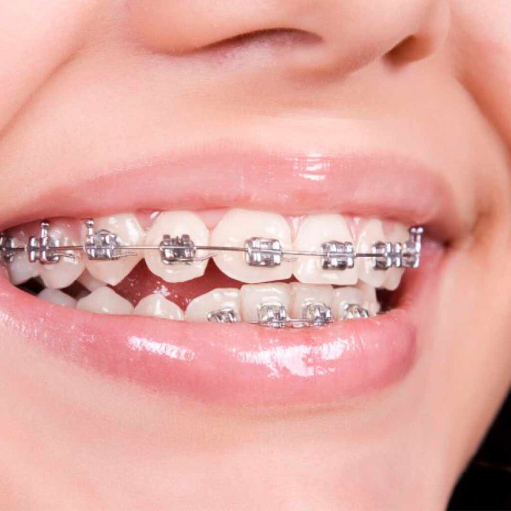 Ortodoncia con brackets metálicos ventajas e inconvenientes • Clínica