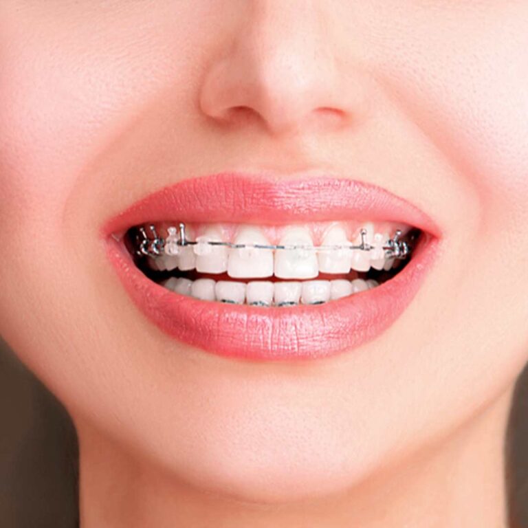 ¿Qué son los brackets autoligables y qué ventajas tienen? • Clínica