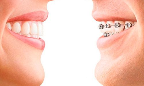 Ortodoncia fija u ortodoncia removible