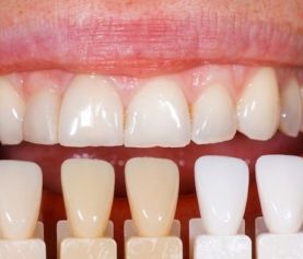 material adhesión dental