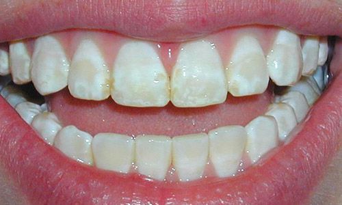 Caso de fluorosis dental