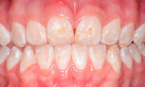 Causas de la hipoplasia dental