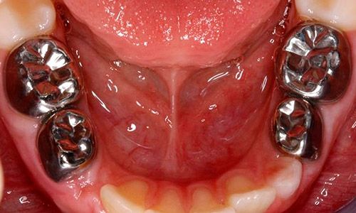 Corona dental metálica
