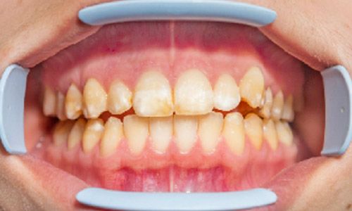 Caso de fluorosis dental en adolescentes