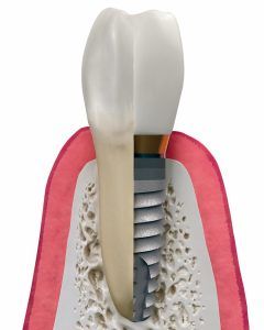 osteointegración en un implants dental