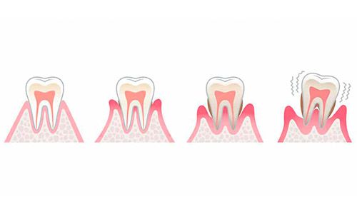 Avance de la enfermedad periodontal