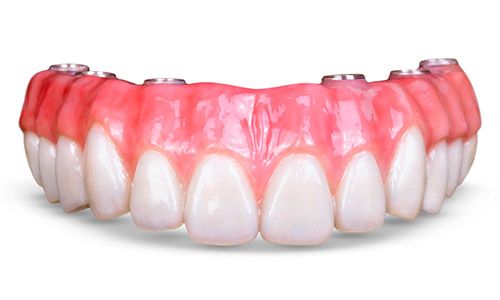 ¿cuánto cuesta una rehabilitación dental completa?