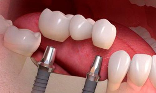 Puente sobre implante dental