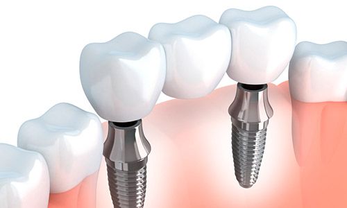 Puente sobre implantes dentales