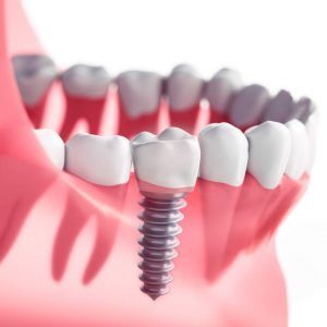 Diente con un implante dental que ha sufrido osteointegración