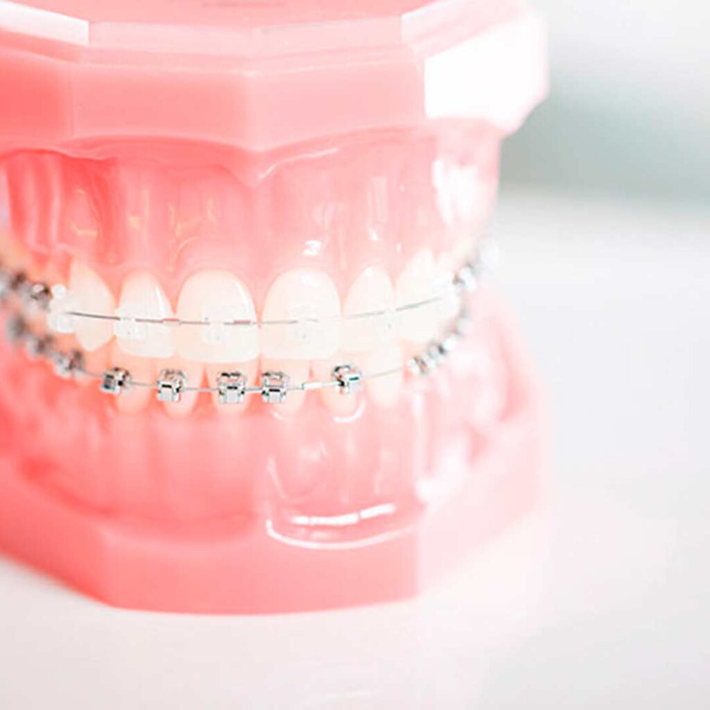 Brackets de zafiro la alternativa estética a los brackets metálicos • Clínica Dental AVODENT