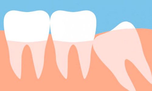 Síntomas de apiñamiento dental