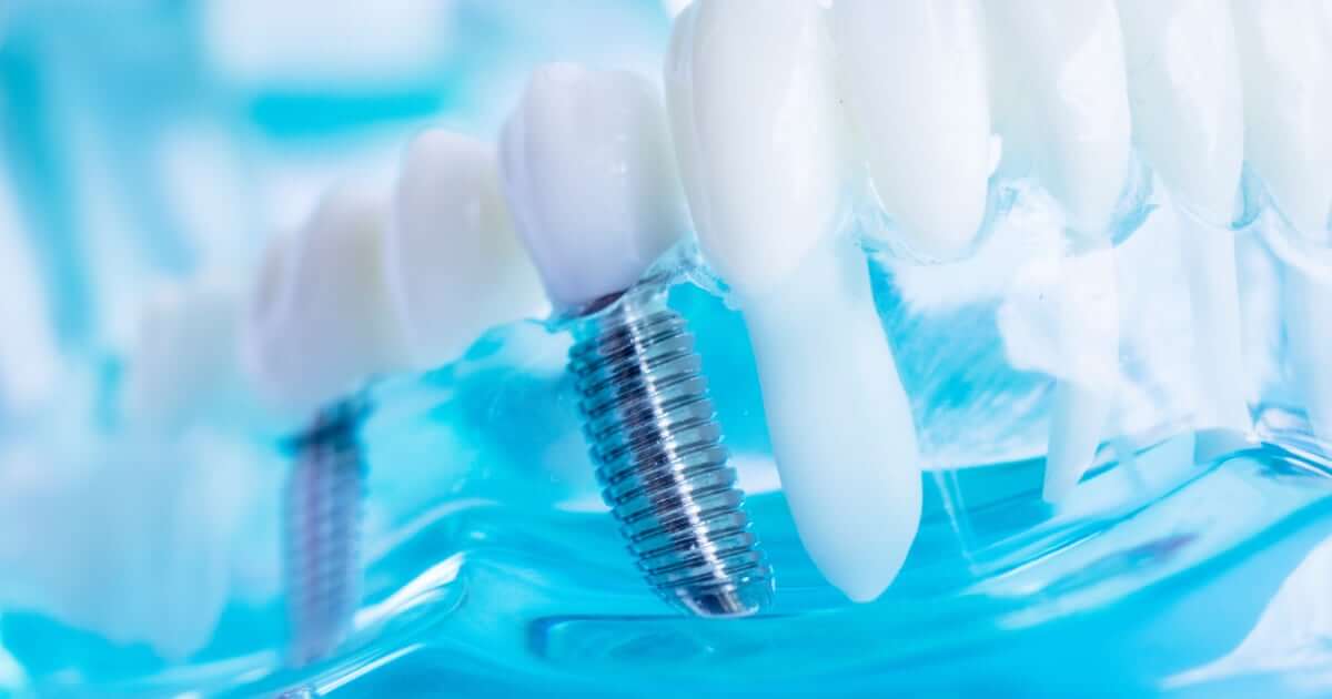 Implantes dentales de carga inmediata