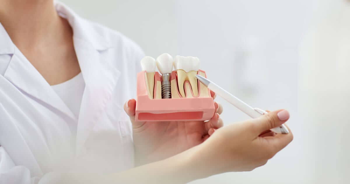 Cómo se colocan los implantes dentales