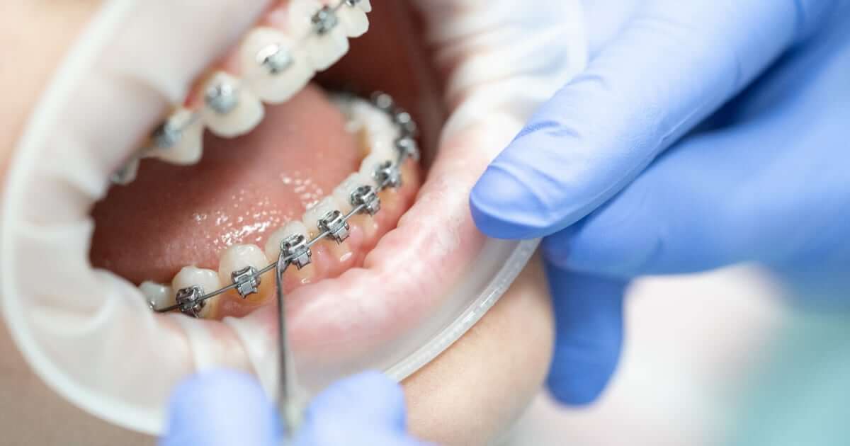 Cuidado ortodoncia de brackets